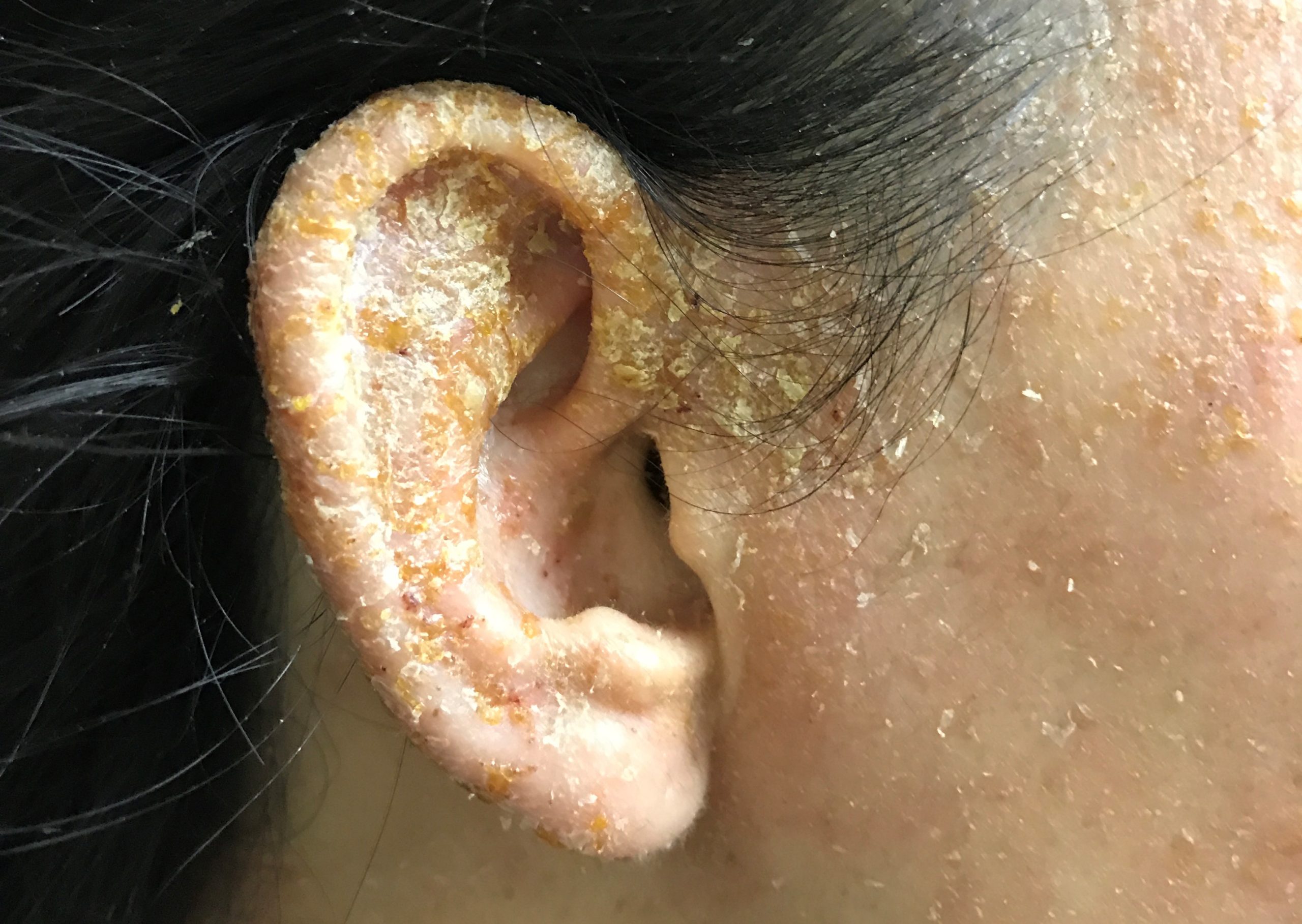 耳 の 中 湿疹